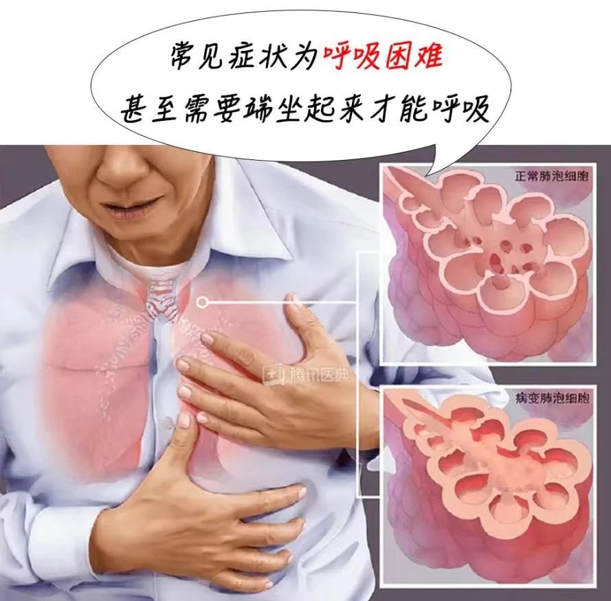 微信图片_20230509145047.jpg 千万别混用!市面上,最常见的家用消毒液主要包括75%酒精、84消毒液和洁厕灵。这三种也是最容易出现事故的,下面逐一介绍它们的使用注意事项。