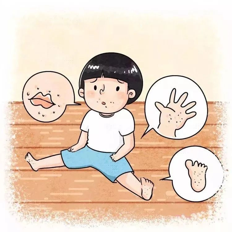 阜阳家长注意 ，手足口病是由肠道病毒引起的一种儿童常见传染病，4~7月为我省手足口病的流行季节。