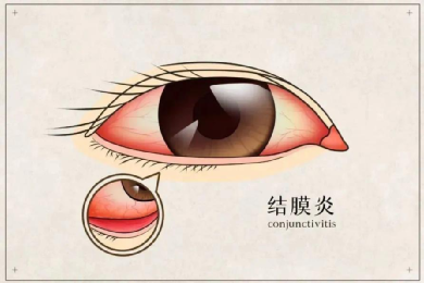 每逢夏秋季  特别是入学后一两周  校园内学生聚集  往往是“红眼病”流行的高发季
