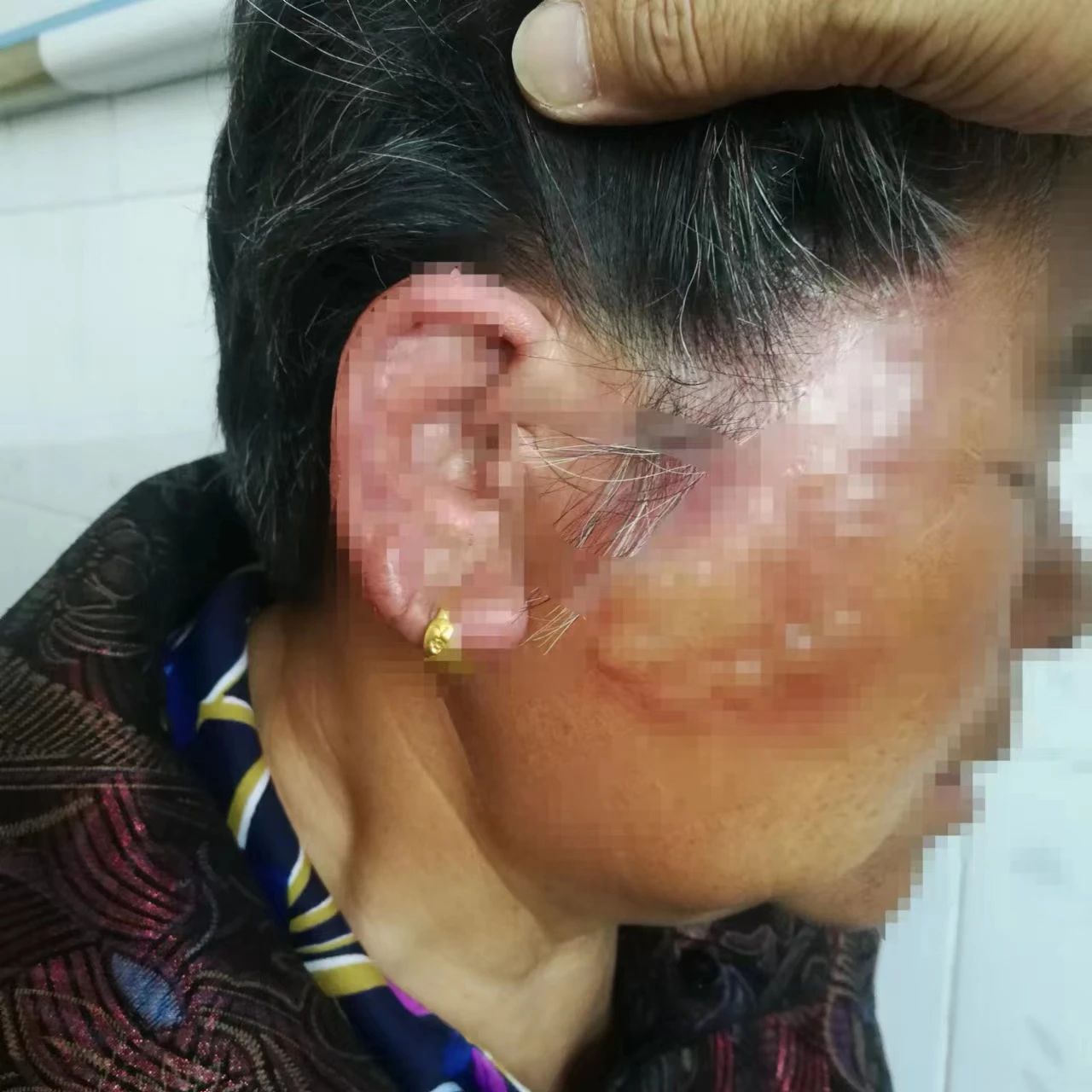 阜阳就诊人数明显增多！一旦感染疼痛难忍…